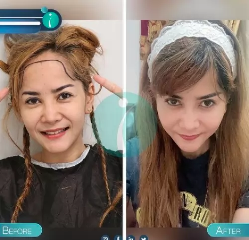 Paket Harga Transplantasi Tanam Rambut Turki di Jakarta